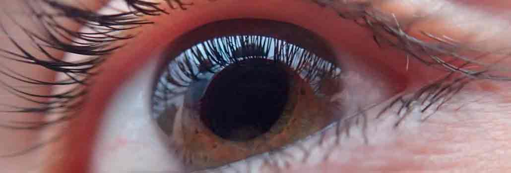 Información sobre el Glaucoma